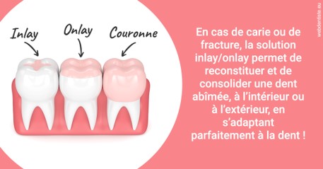https://dr-membrado-daniel.chirurgiens-dentistes.fr/L'INLAY ou l'ONLAY 2
