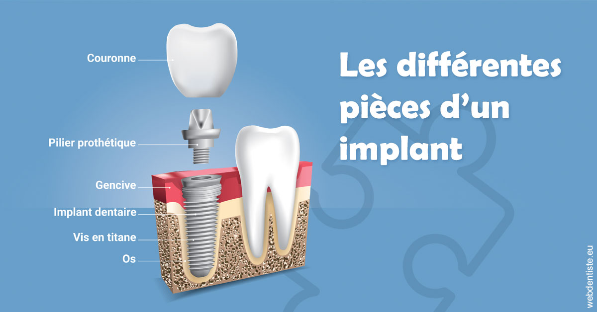 https://dr-membrado-daniel.chirurgiens-dentistes.fr/Les différentes pièces d’un implant 1